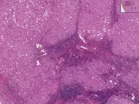Chronic active hepatitis, cirrhosis