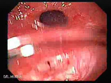 Ileal Neobladder Substitution (ileal bladder) (4 of 9)