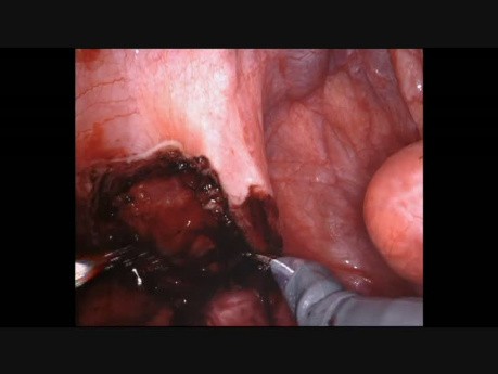 Excision of Endometriosis with Sigmoid Colectomy and Intracorporeal Anastomosis