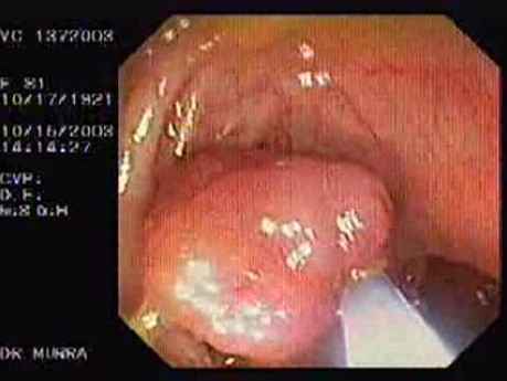 Tubulo - Villous Adenoma - Endoscopy (6 of 28)