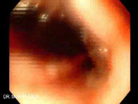 Upper GI Bleeding Due to Esophageal Varices - Lavage Reveals the Recent Site of Bleeding