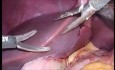  Biliary Laparoscopic Approach in Living Liver Donor with Two Portal Veins and Two Bile Ducts in Right Lobe Graft