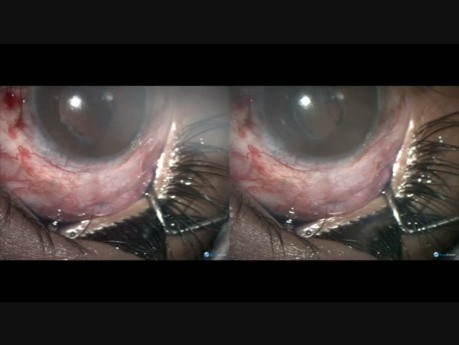 Buphthalmos Surgery Complication - Management