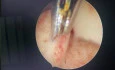 Polypectomy