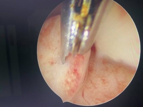 Polypectomy