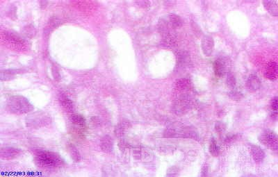 Barrett's Ulcer (5 of 5 )