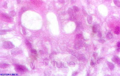 Barrett's Ulcer (5 of 5 )