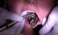 Finishing Crown Margin After Cementation