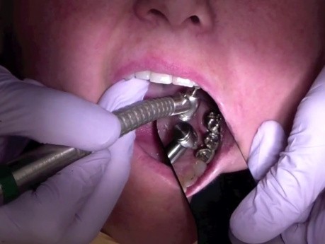 Finishing Crown Margin After Cementation