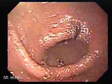 Upper Gastrointestinal Bleeding - Rest of Blood