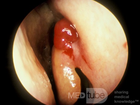Capillary Hemangioma