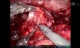 Robotic Assisted Secondary CytoreductionIn Case of Carcinoma Ovary