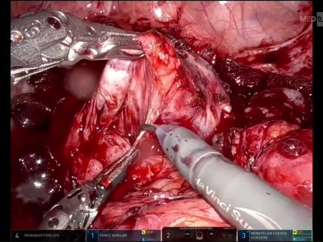 Robotic Assisted Secondary CytoreductionIn Case of Carcinoma Ovary