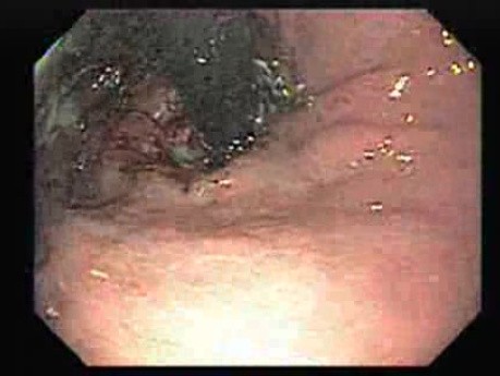 Adenocarcinoma of the Esophagus and Gastric Fundus (3 of 3)
