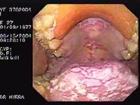 Oropharynge-Esophagic Candidiasis - leucoplasie on the buccal mucosus (4 of 5)