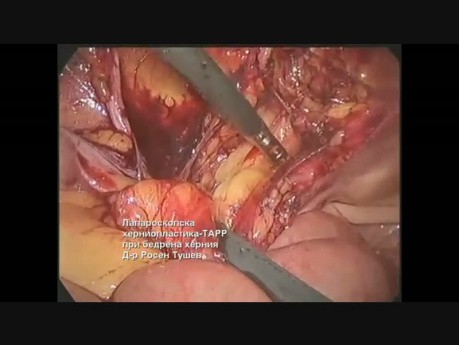 Laparoscopic TAPP Hernia Repair For Left Femoral Hernia