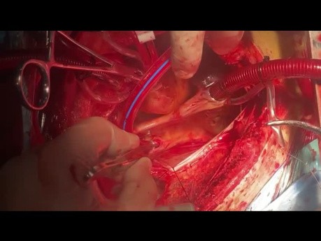 Patient with Multiple Systemic Embolism and MV Regurgitation as Well as Stenosis