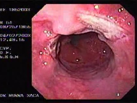 Banding of Esophageal Varices - Exudative Ulcer