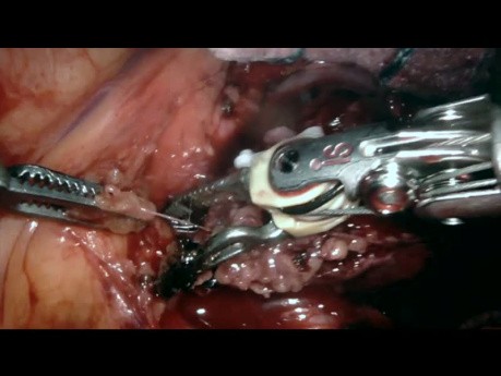 Resection of Aorto-Pulmonary Window Tumour Mass, Robot-Assisted Surgery