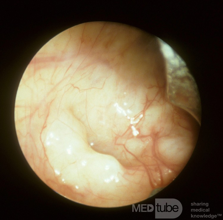 Dental Roots Floor of Right Maxillary Sinus