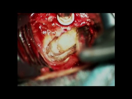 Cervical Myelopathy