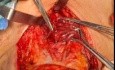Recurrant Laryngeal Nerve & Parathyroid Glands in LT Hemithyroidectomy
