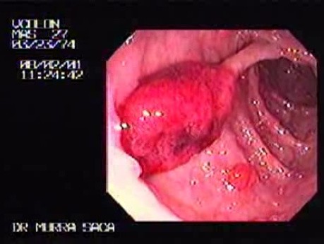 Stalked Polyp