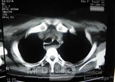 Esophagus - Pneumatic Dilation for Achalasia (25 of 31)