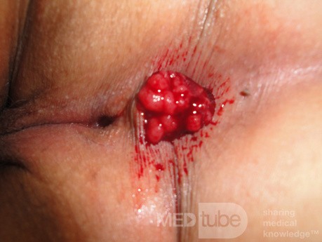 Endoscopic Resection of Giant Tubulo-Villous of
 the rectum (1 of 35)