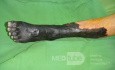 Dry gangrene left lower limb in diabetic patient