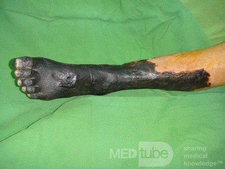 Dry gangrene left lower limb in diabetic patient
