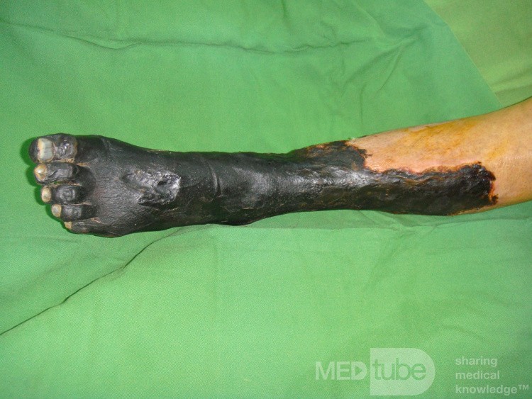 Dry gangrene left lower limb in diabetic patient