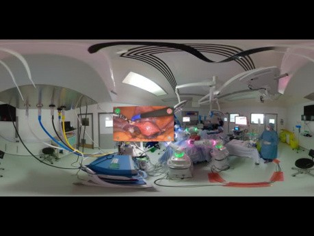 360° Versius Hysterectomy at Milton Keynes University Hospital