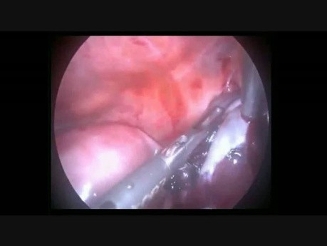 Laparoscopic Manegment Of Hemoperitoneum Due to Hemorraghic Cyst