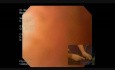 Endoscopic Adjustable Gastric Band Removal