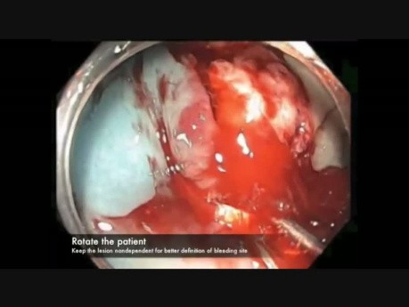 Cecum-EMR Bleed-Position Change-D