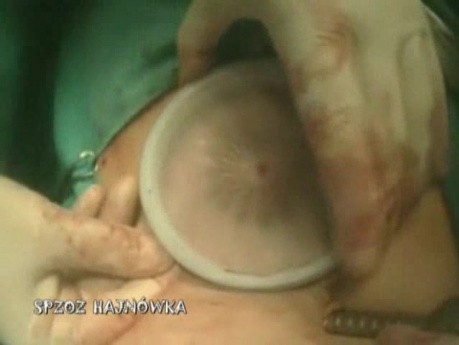 Laparoscopic Right Hemicolectomy
