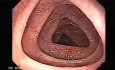 Colonoscopy video