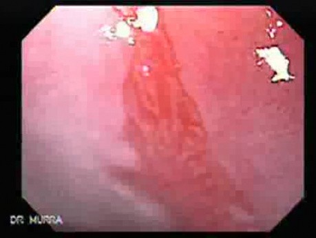 Endoscopic view of Barrett Esophagus magnifying endoscopy (2 of 9)