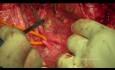 Ovarian Cancer Cytoreductive Surgery. The Modified Posterior Pelvic Exenteration.