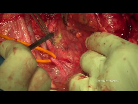 Ovarian Cancer Cytoreductive Surgery. The Modified Posterior Pelvic Exenteration.