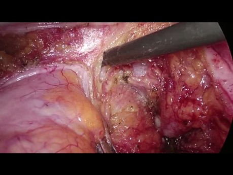 Recurrent Rectal Cancer - Laparoscopic Completion TME