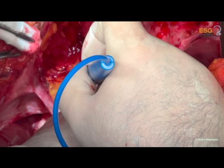 Ovarian Cancer Cytoreductive Surgery. Unedited version. Part I Upper Abdomen.