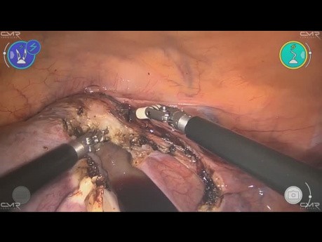 Hysterectomy with Versius