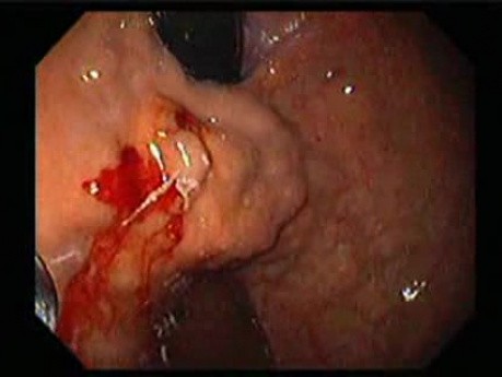 Gastric Varices - Endoscopic Ablation With Cyanoacrylate Glue (6 of 18)