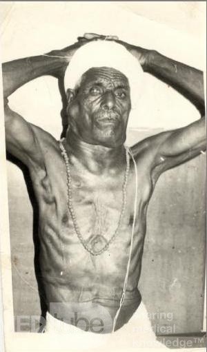 Malignant Lymphadenopathy