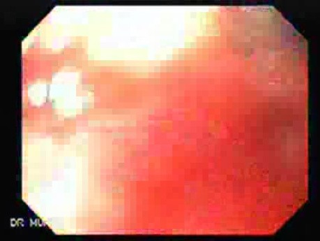 Adenocarcinoma of the Cardias - Endoscopic Maneuvers During Stent Placement