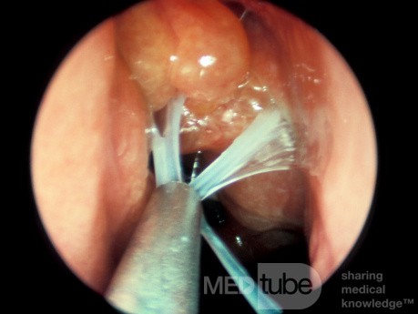 ASA Triad Mucus