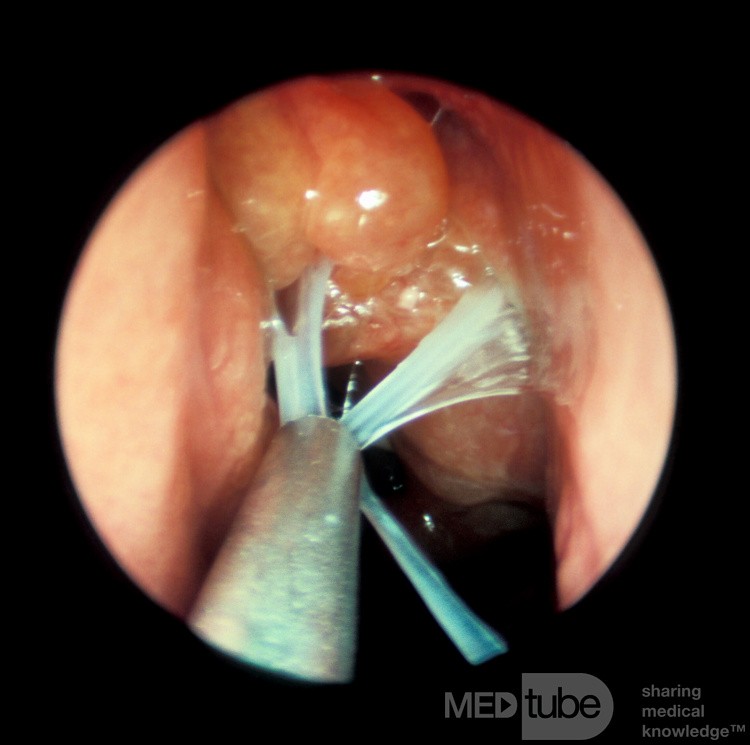 ASA Triad Mucus