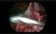 Laparoscopic Surgery of Huge Ovarian Cystic Teratoma In Pregnancy